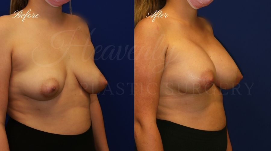 breast augmentation, breast augmentation surgery, breast augmentation surgeon, breast augmentation orange county, breast augmentation with silicone implants, sientra implants, boob job, boob job surgeon, breast implant surgeon, plastic surgery orange county, lake forest plastic surgeon, breast augmentation lake forest, south oc plastic surgeon