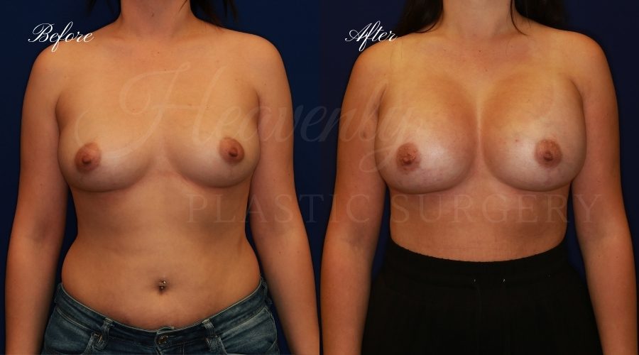 breast augmentation, breast augmentation surgery, breast augmentation surgeon, breast augmentation orange county, breast augmentation with silicone implants, sientra implants, boob job, boob job surgeon, breast implant surgeon, plastic surgery orange county, lake forest plastic surgeon, breast augmentation lake forest, south oc plastic surgeon