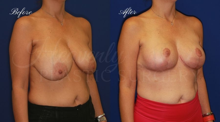 breast implant removal, breast implant removal surgeon, breast explant surgeon, breast explant with lift, breast explant orange county, oragnge county breast implant removal surgeon, implant removal surgery, breast lift, breast lift with explantation orange county