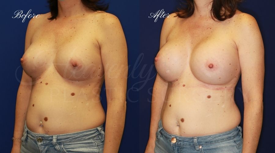 Plastic surgery, plastic surgeon, breast surgery, breast implant revision, deflated breast implant, breast augmentation correction, implant exchange, breast implants, implant exchange, breast implant exchange