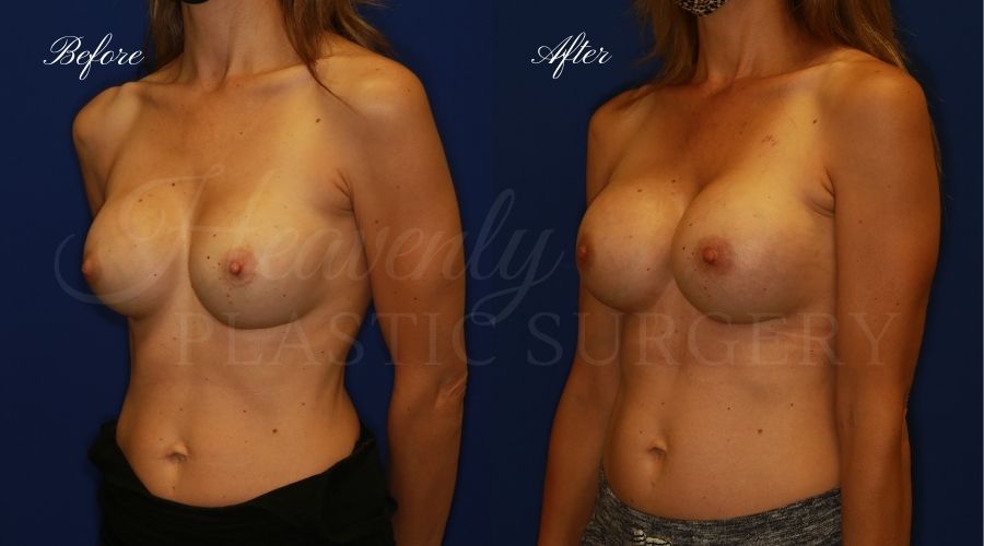 Plastic surgery, plastic surgeon, breast surgery, breast implant revision, deflated breast implant, breast augmentation correction, implant exchange, breast implants, implant exchange, breast implant exchange