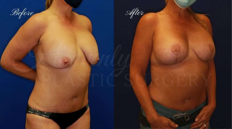 Breast Lift with Implants (Mastopexy-Augmentation) Before and After, Heavenly Plastic Surgery, Plastic Surgery, Plastic Surgeon, Breast Surgery, Breast Lift, Breast Lift with Implants, Breast Implants