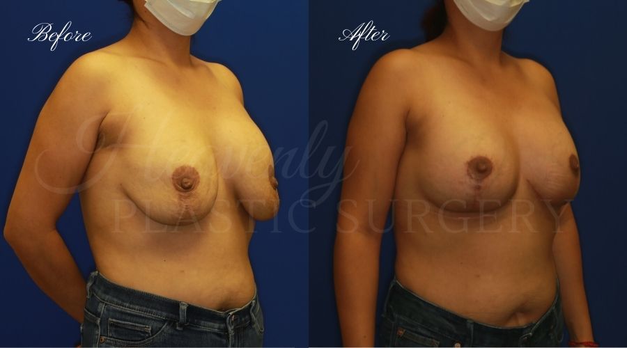 Breast Lift with Implants Before and After, Mastopexy Augmentation (Breast Implants with Lift) - 310cc SRM Silicone breast implants with Wise-pattern breast lift (Anchor scar), plastic surgery