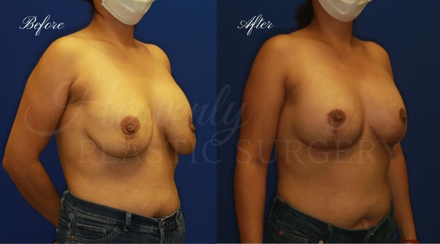 Breast Lift with Implants Before and After, Mastopexy Augmentation (Breast Implants with Lift) - 310cc SRM Silicone breast implants with Wise-pattern breast lift (Anchor scar), plastic surgery Breast Lift with Implants Before and After, Mastopexy Augmentation (Breast Implants with Lift) - 310cc SRM Silicone breast implants with Wise-pattern breast lift (Anchor scar), plastic surgery