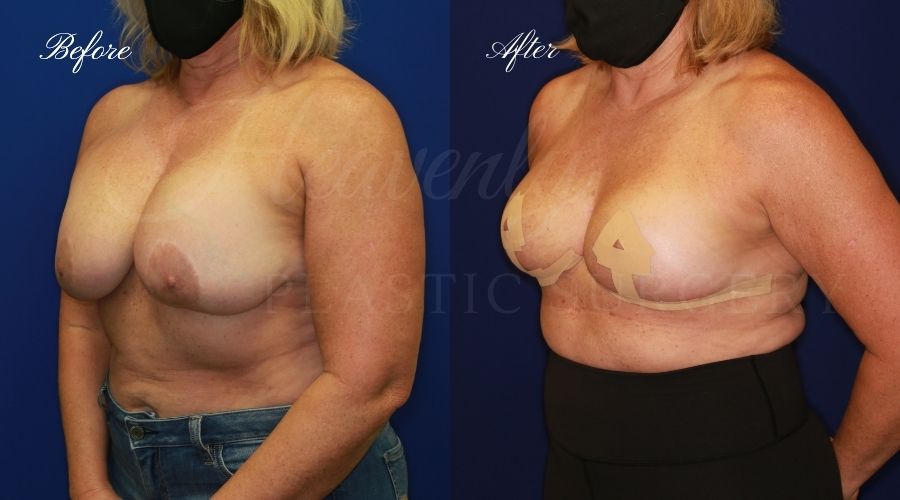 explant surgery, breast implant removal, breast implant removal surgery, implant removal, breast implant removal and breast lift, breast lift, breast lift surgery, explant before and after, implant removal before and after, implant removal surgeon, breast implant removal surgeon, breast implant removal orange county, breast lift surgeon