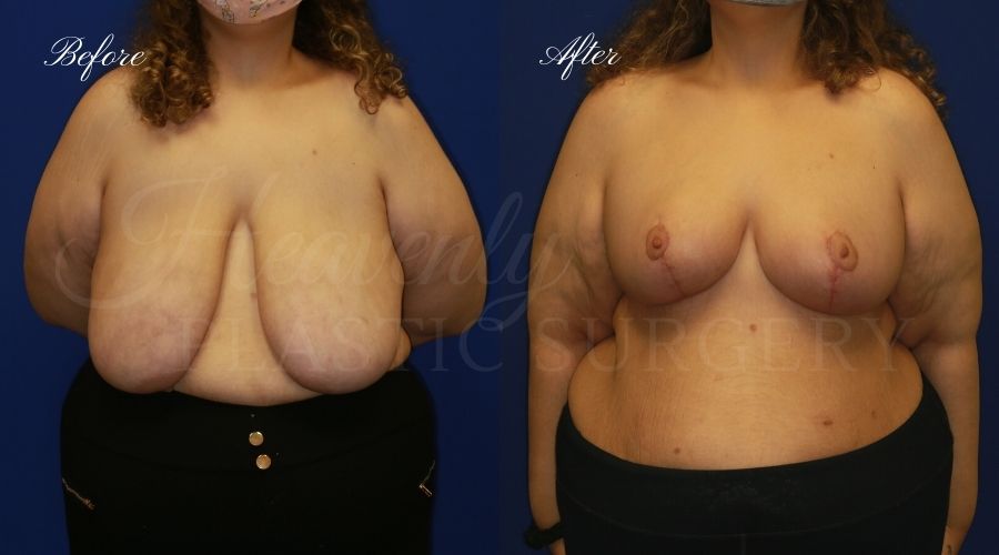 Plastic surgery, plastic surgeon, breast reduction, breast lift, reduction mammaplasty, mastopexy, before and after Plastic surgery, plastic surgeon, breast reduction, breast lift, reduction mammaplasty, mastopexy, before and after