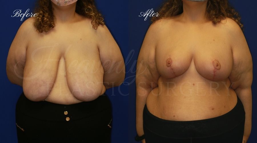 Plastic surgery, plastic surgeon, breast reduction, breast lift, reduction mammaplasty, mastopexy, before and after