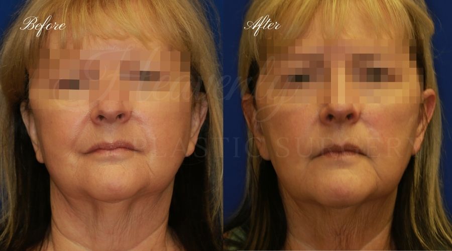 buccal fat pad removal, buccal fat removal, buccal fat pad removal orange county, buccal fat surgeon, buccal fat surgery, cheek fat removal, cheek fat surgery, cheek fat surgeon, cheek surgery before and after, buccal fat pad removal before and after, buccal fat before and after, facelift, face lift, neck lift