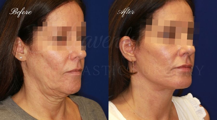 face lift, neck lift, face lift before and after, neck lift before and after, face lift surgeon, facelift, neck lift surgeon, face plastic surgeon, palstic surgeon, facelift orange county, face lift orange county, neck lift orange county, lower face lift, lower face lift orange county, neck lift orange county, orange county plastic surgeon, orange county plastic surgery
