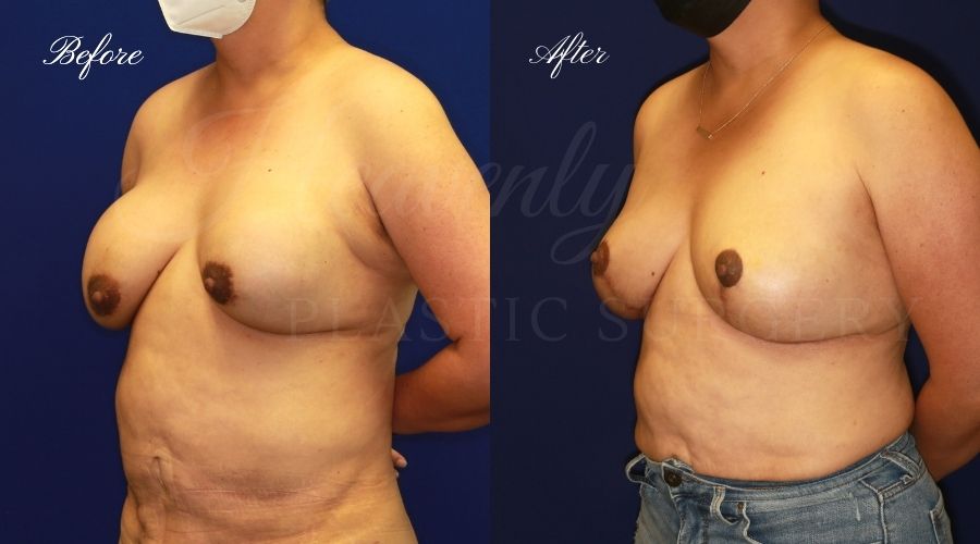 Implant Exchange + Breast Lift + Capsulectomy Before and After - Left Oblique TRBI implant exchange surgery, capsulectomy surgery, breast implant exchange, breast implant capsulectomy, capsular contracture, capsular contracture surgery, capsulectomy surgeon, capsular contracture surgeon, breast implant exchange orange county, capsulectomy surgeon