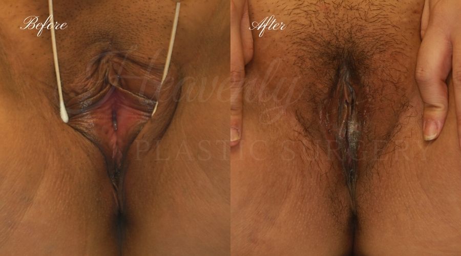 labiaplasty before and after, vagina skin surgery before and after, extra labia skin, vagina surgery before and after, labiaplasty orange county, labiaplasty los angeles, labiaplasty surgeon, labiaplasty near me, vaginal rejuvination labiaplasty before and after, vagina skin surgery before and after, extra labia skin, vagina surgery before and after, labiaplasty orange county, labiaplasty los angeles, labiaplasty surgeon, labiaplasty near me, vaginal rejuvination