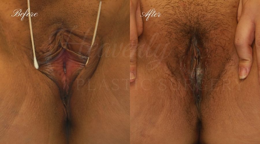 labiaplasty before and after, vagina skin surgery before and after, extra labia skin, vagina surgery before and after, labiaplasty orange county, labiaplasty los angeles, labiaplasty surgeon, labiaplasty near me, vaginal rejuvination