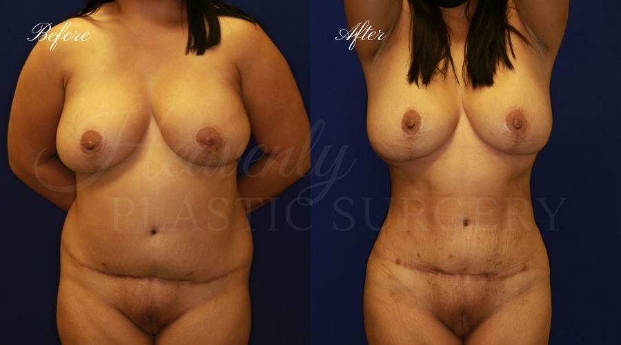 BBL Orange county, brazilian butt lift orange county, brazilian butt lift before and after, brazilian butt lift surgeon, brazilian butt lift results, bbl surgeon, bbl results, bbl before and after, fat transfer to the butt, butt augmentation, butt augmentation surgery, butt augmentation surgeon