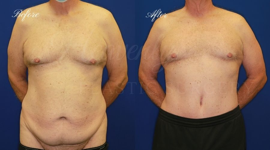 male tummy tuck, male tummy tuck before and after, tummy tuck before and after, male tummy tuck surgeon, tummy tuck orange county, male tummy tuck orange county, abdominoplasty surgeon, male abdominoplasty