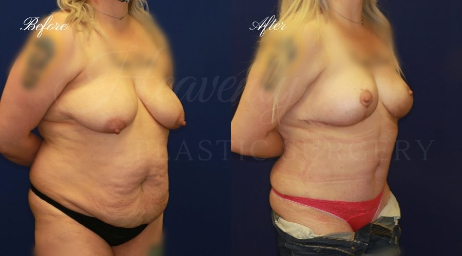 mommy makeover before and after, tummy tuck before and after, breast lift before and after, mommy makeover results, mommy makeover journey, mommy makeover surgeon, tummy tuck surgeon, breast lift surgeon, breast lift surgery, tummy tuck surgery, plastic surgeon orange county, orange county plastic surgery, mommy makeover orange county
