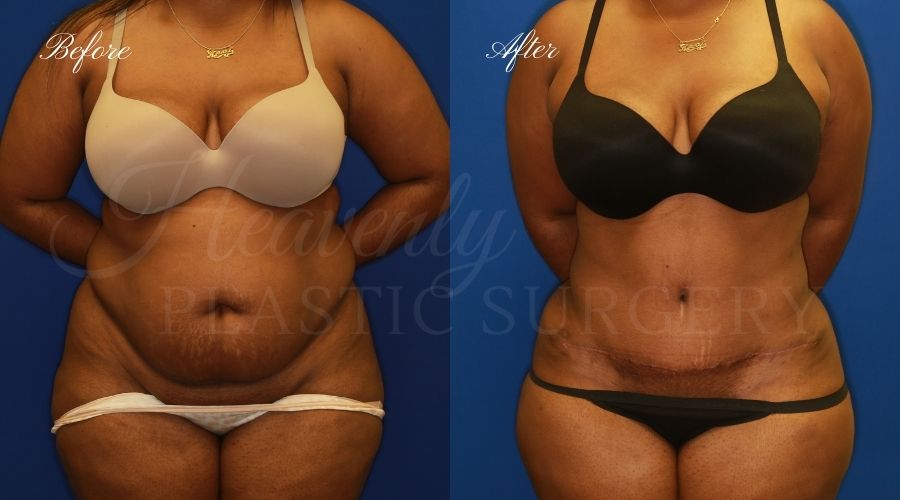 Plastic Surgery, Plastic Surgeon, Tummy Tuck, Abdominoplasty, Tummy Tuck with Lipo, Liposuction, Orange County Plastic Surgeon, Orange County Plastic Surgery, Fupa, Fupa surgery, fupa surgeon