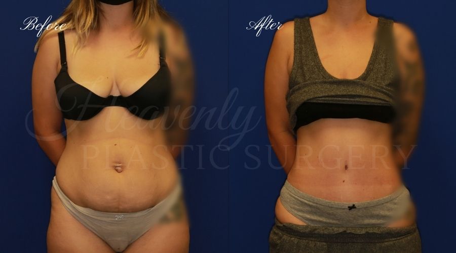 Plastic Surgery, plastic surgeon, tummy tuck, abdominoplasty, weight loss