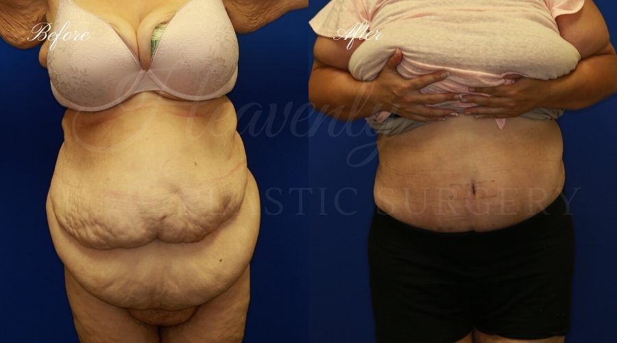 extended tummy tuck before and after, tummy tuck before and after, extended tummy tuck, large tummy tuck, plus sized tummy tuck, large tummy tuck before and after, tummy tuck surgeon, tummy tuck surgery, abdominoplasty, large abdominoplasty, weight loss surgery, weight loss tummy tuck,plastic surgery transformation
