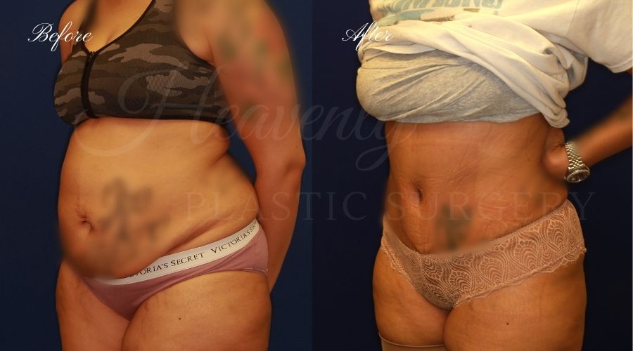 Plastic Surgery, Plastic Surgeon, Tummy Tuck, Abdominoplasty, Tummy Tuck with Lipo, Liposuction, Orange County Plastic Surgeon, Orange County Plastic Surgery, Fupa, Fupa surgery, fupa surgeon Plastic Surgery, Plastic Surgeon, Tummy Tuck, Abdominoplasty, Tummy Tuck with Lipo, Liposuction, Orange County Plastic Surgeon, Orange County Plastic Surgery, Fupa, Fupa surgery, fupa surgeon