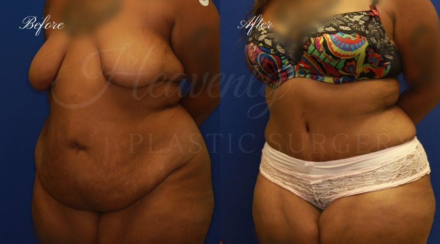 extended tummy tuck before and after, tummy tuck before and after, extended tummy tuck, large tummy tuck, plus sized tummy tuck, large tummy tuck before and after, tummy tuck surgeon, tummy tuck surgery, abdominoplasty, large abdominoplasty, weight loss surgery