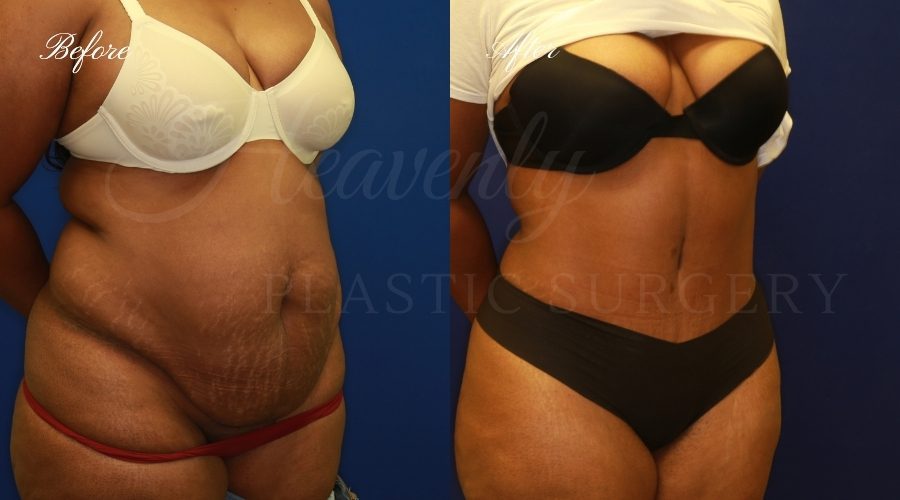 Plastic Surgery, Plastic Surgeon, Tummy Tuck, Abdominoplasty, Tummy Tuck with Lipo, Liposuction, Orange County Plastic Surgeon, Orange County Plastic Surgery, Fupa, Fupa surgery, fupa surgeon