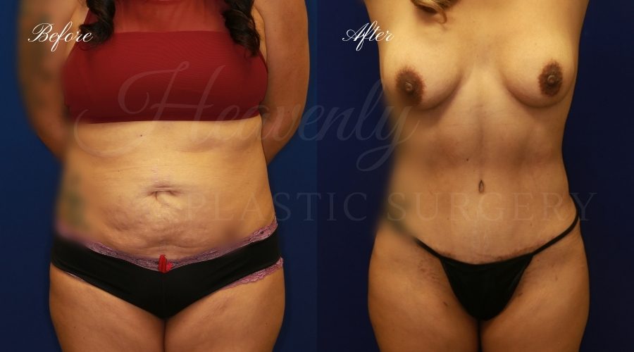 tummy tuck before and after, liposuction before and after, tummy tuck with liposuction, liposuction before and after, tummy tuck orange county, liposuction orange county, lipoetching