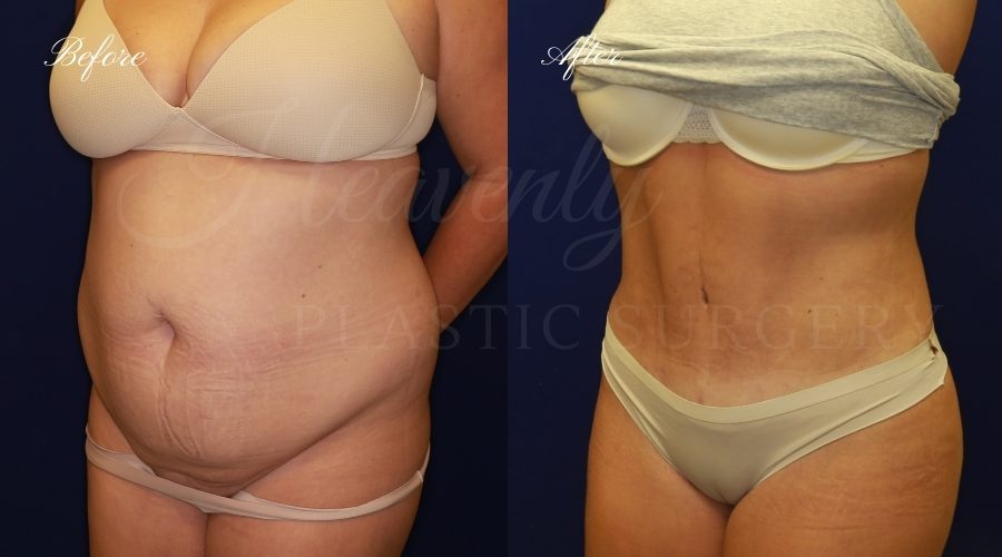 tummy tuck before and after, liposuction before and after, tummy tuck with liposuction, liposuction before and after, tummy tuck orange county, liposuction orange county, lipoetching