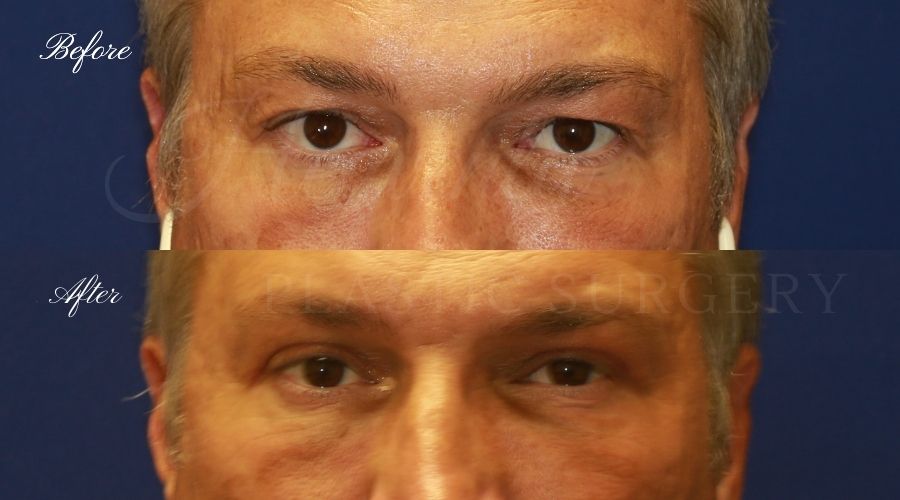 Plastic Surgery, Plastic Surgeon, Eyelid Surgery, Upper blepharoplasty, blepharoplasty, upper eyelids, upper eyelid surgery Plastic Surgery, Plastic Surgeon, Eyelid Surgery, Upper blepharoplasty, blepharoplasty, upper eyelids, upper eyelid surgery
