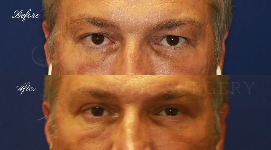 Plastic Surgery, Plastic Surgeon, Eyelid Surgery, Upper blepharoplasty, blepharoplasty, upper eyelids, upper eyelid surgery