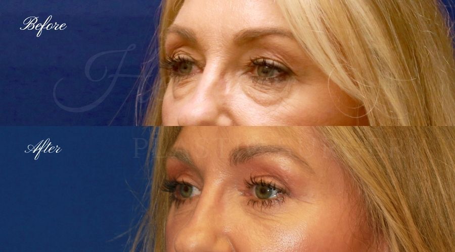 Plastic Surgery, Plastic Surgeon, Eyelid Surgery, Upper blepharoplasty, blepharoplasty, upper eyelids, upper eyelid surgery Plastic Surgery, Plastic Surgeon, Eyelid Surgery, Upper blepharoplasty, blepharoplasty, upper eyelids, upper eyelid surgery