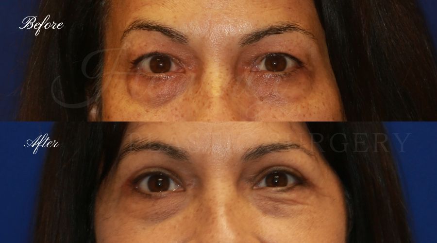 Plastic Surgery, Plastic Surgeon, Eyelid Surgery, Upper blepharoplasty, blepharoplasty, upper eyelids, upper eyelid surgery Plastic Surgery, Plastic Surgeon, Eyelid Surgery, Upper blepharoplasty, blepharoplasty, upper eyelids, upper eyelid surgery