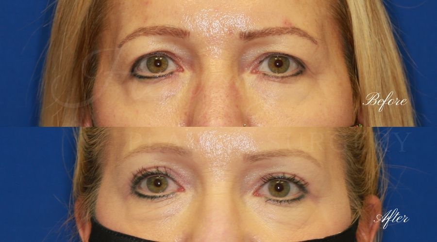 Plastic Surgery, Plastic Surgeon, Eyelid Surgery, Upper blepharoplasty, blepharoplasty, upper eyelids, upper eyelid surgery Plastic Surgery, Plastic Surgeon, Eyelid Surgery, Upper blepharoplasty, blepharoplasty, upper eyelids, upper eyelid surgery