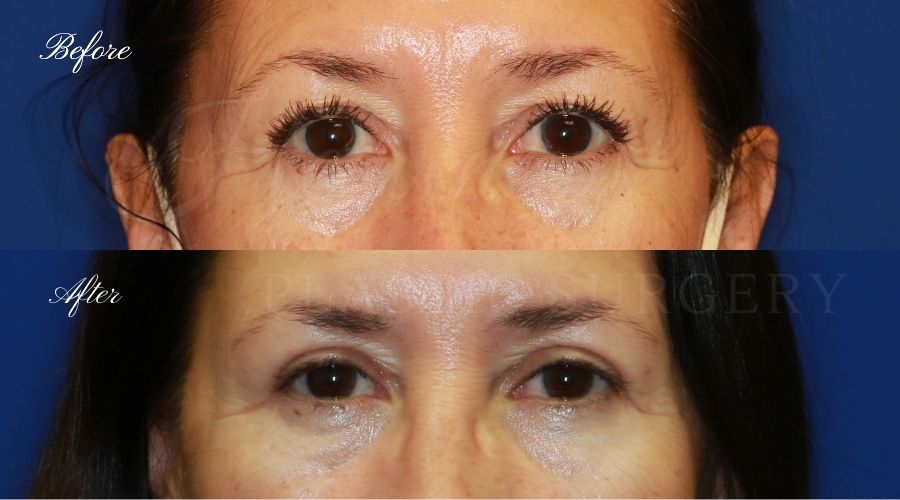 Plastic Surgery, Plastic Surgeon, Eyelid Surgery, Upper blepharoplasty, blepharoplasty, upper eyelids, upper eyelid surgery Plastic Surgery, Plastic Surgeon, Eyelid Surgery, Upper blepharoplasty, blepharoplasty, upper eyelids, upper eyelid surgery