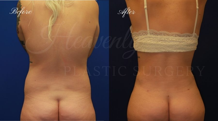 tummy tuck before and after, liposuction before and after, tummy tuck with liposuction, liposuction before and after, tummy tuck orange county, liposuction orange county, lipoetching