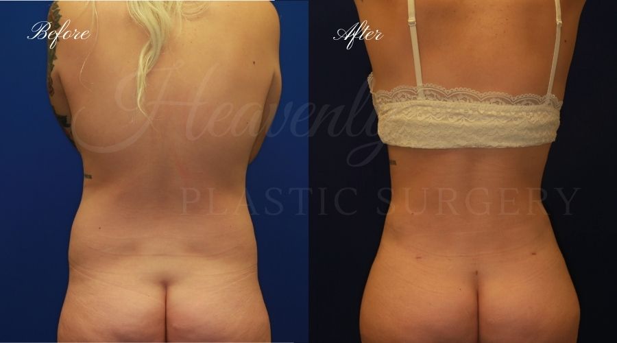 Liposuction of Back and Flanks - Associates in Plastic Surgery