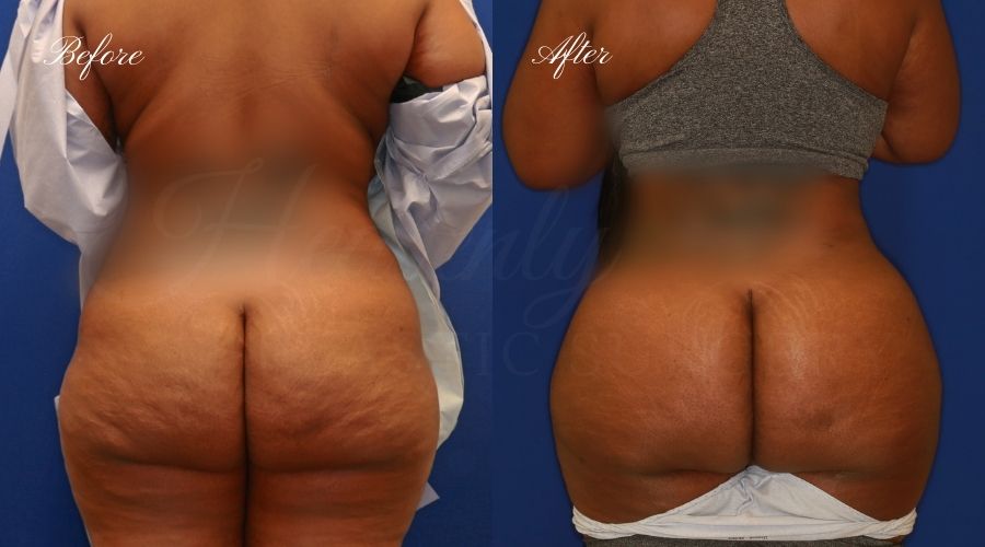 BBL Orange county, brazilian butt lift orange county, brazilian butt lift before and after, brazilian butt lift surgeon, brazilian butt lift results, bbl surgeon, bbl results, bbl before and after, fat transfer to the butt, butt augmentation, butt augmentation surgery, butt augmentation surgeon
