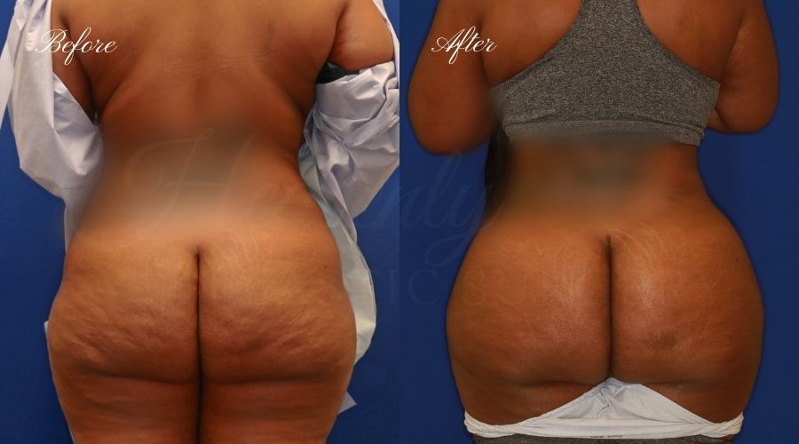 BBL Orange county, brazilian butt lift orange county, brazilian butt lift before and after, brazilian butt lift surgeon, brazilian butt lift results, bbl surgeon, bbl results, bbl before and after, fat transfer to the butt, butt augmentation, butt augmentation surgery, butt augmentation surgeon BBL Orange county, brazilian butt lift orange county, brazilian butt lift before and after, brazilian butt lift surgeon, brazilian butt lift results, bbl surgeon, bbl results, bbl before and after, fat transfer to the butt, butt augmentation, butt augmentation surgery, butt augmentation surgeon