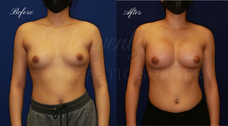 breast augmentation, breast augmentation surgery, breast augmentation surgeon, breast augmentation orange county, breast augmentation with silicone implants, sientra implants, boob job, boob job surgeon, breast implant surgeon, plastic surgery orange county, lake forest plastic surgeon, breast augmentation lake forest, south oc plastic surgeon breast augmentation, breast augmentation surgery, breast augmentation surgeon, breast augmentation orange county, breast augmentation with silicone implants, sientra implants, boob job, boob job surgeon, breast implant surgeon, plastic surgery orange county, lake forest plastic surgeon, breast augmentation lake forest, south oc plastic surgeon