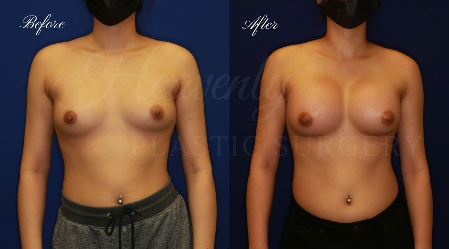 breast augmentation, breast augmentation surgery, breast augmentation surgeon, breast augmentation orange county, breast augmentation with silicone implants, sientra implants, boob job, boob job surgeon, breast implant surgeon, plastic surgery orange county, lake forest plastic surgeon, breast augmentation lake forest, south oc plastic surgeon