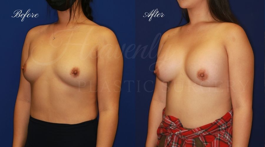 breast augmentation, breast augmentation surgery, breast augmentation surgeon, breast augmentation orange county, breast augmentation with silicone implants, sientra implants, boob job, boob job surgeon, breast implant surgeon, plastic surgery orange county, lake forest plastic surgeon, breast augmentation lake forest, south oc plastic surgeon