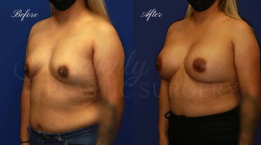 breast augmentation, breast augmentation surgery, breast augmentation surgeon, breast augmentation orange county, breast augmentation with silicone implants, sientra implants, boob job, boob job surgeon, breast implant surgeon, plastic surgery orange county, lake forest plastic surgeon, breast augmentation lake forest, south oc plastic surgeon