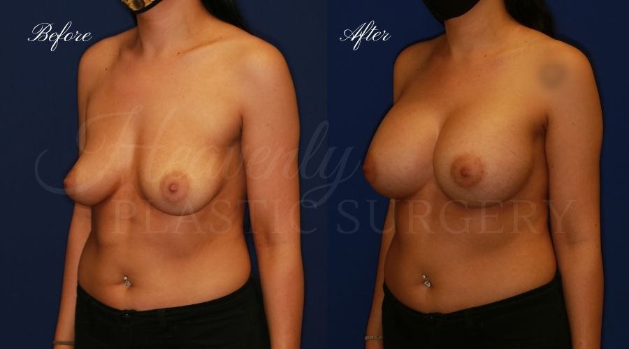 breast augmentation, breast augmentation surgery, breast augmentation surgeon, breast augmentation orange county, breast augmentation with silicone implants, sientra implants, boob job, boob job surgeon, breast implant surgeon, plastic surgery orange county, lake forest plastic surgeon, breast augmentation lake forest, south oc plastic surgeon