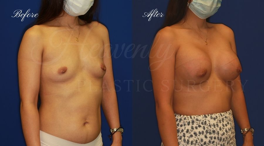 breast augmentation, breast augmentation surgery, breast augmentation surgeon, breast augmentation orange county, breast augmentation with silicone implants, sientra implants, boob job, boob job surgeon, breast implant surgeon, plastic surgery orange county, lake forest plastic surgeon, breast augmentation lake forest, south oc plastic surgeon