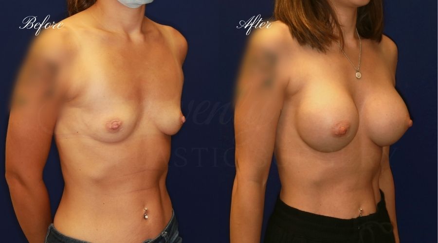 breast augmentation, breast augmentation surgery, breast augmentation surgeon, breast augmentation orange county, breast augmentation with silicone implants, sientra implants, boob job, boob job surgeon, breast implant surgeon, plastic surgery orange county, lake forest plastic surgeon, breast augmentation lake forest, south oc plastic surgeon