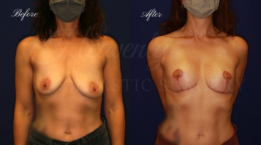 Breast lift surgery, breast lift, breast lift surgeon, mastopexy, mastopexy surgery, breast lift without implants, breast lift orange county, plastic surgery before and after, breast lift before and after, breast lift results, breast reduction, breast reduction results, plastic surgeon, plastic surgery, orange county plastic surgery, orange county plastic surgeon