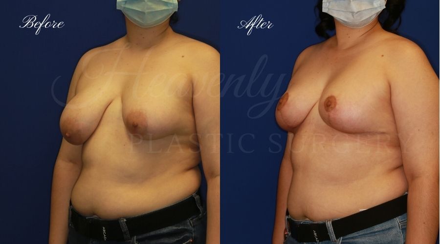 Breast lift surgery, breast lift, breast lift surgeon, mastopexy, mastopexy surgery, breast lift without implants, breast lift orange county, plastic surgery before and after, breast lift before and after, breast lift results, breast reduction, breast reduction results, plastic surgeon, plastic surgery, orange county plastic surgery, orange county plastic surgeon