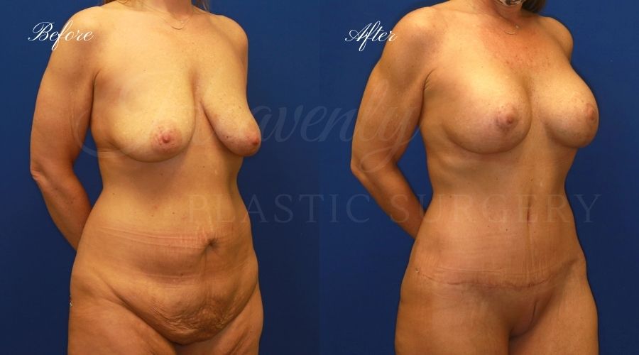 Heavenly Plastic Surgery, Plastic Surgery, Plastic Surgeon, Mommy Makeover, Transformation, Breast Lift, Tummy Tuck, Breast lift without implants, Breast Surgery, Body Surgery, Tummy Tuck, Tummy Tuck with Liposuction, Liposuction