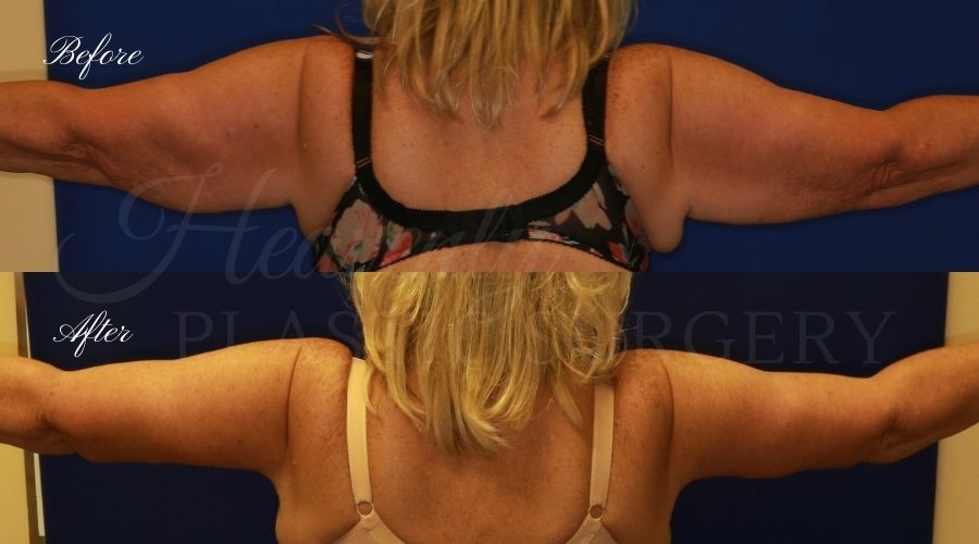 Mommy Makeover - Arm Lift + Tummy Tuck - Back LEGI Mommy Makeover - Arm Lift + Tummy Tuck - Back LEGI