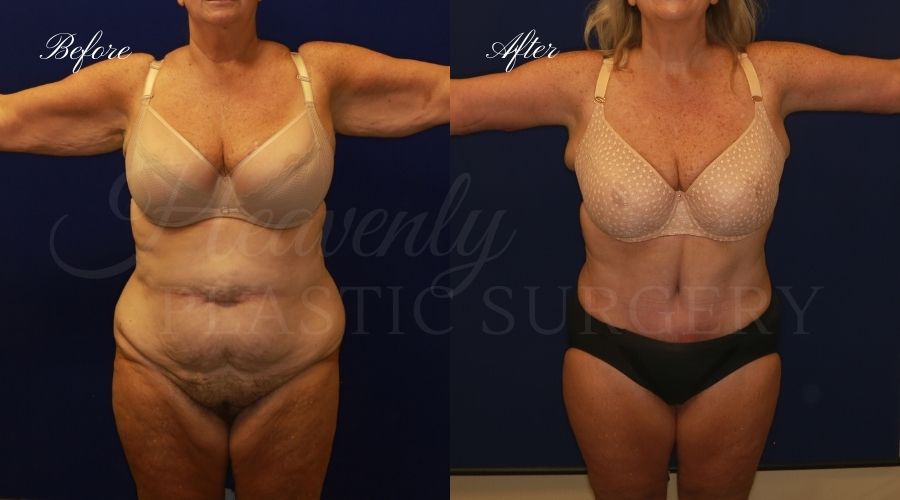mommy makeover before and after, tummy tuck before and after, arm lift before and after, mommy makeover surgeon, arm lift surgeon, tummy tuck surgeon, arm lift orange county, tummy tuck orange county, brachioplasty orange county, brachioplasty surgery, brachioplasty surgeon
