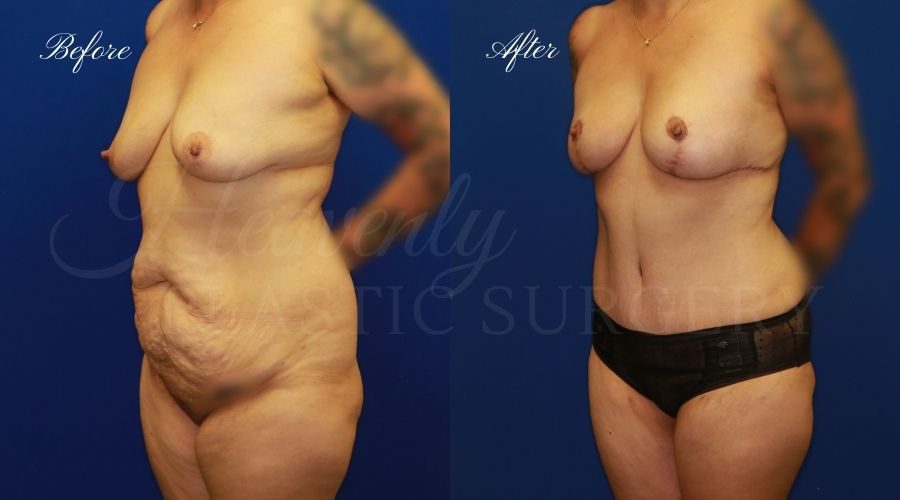 tummy tuck, tummy tuck before and after, breast lift before and after, breast lift results, tummy tuck breast lift surgeon, mommy makeover, mommy makeover before and after, mommy makeover surgeon, mommy makeover orange county, axillary breast tissue excision, accessory breast tissue removal, breast tissue removal, excess breast tissue removal